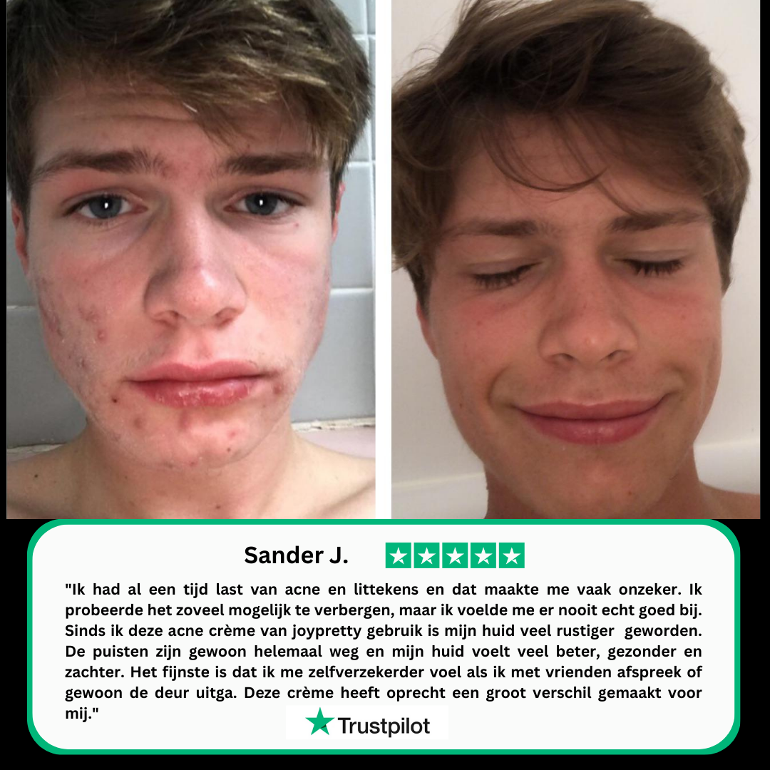 Crema Tratante para el Acné