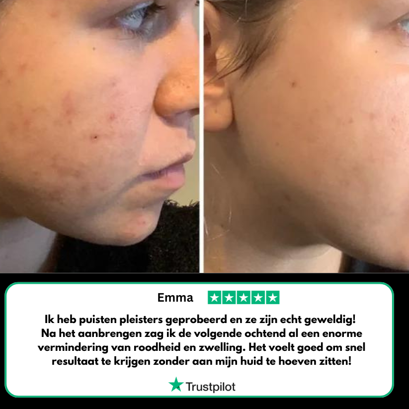 Acne-puisten pleisters